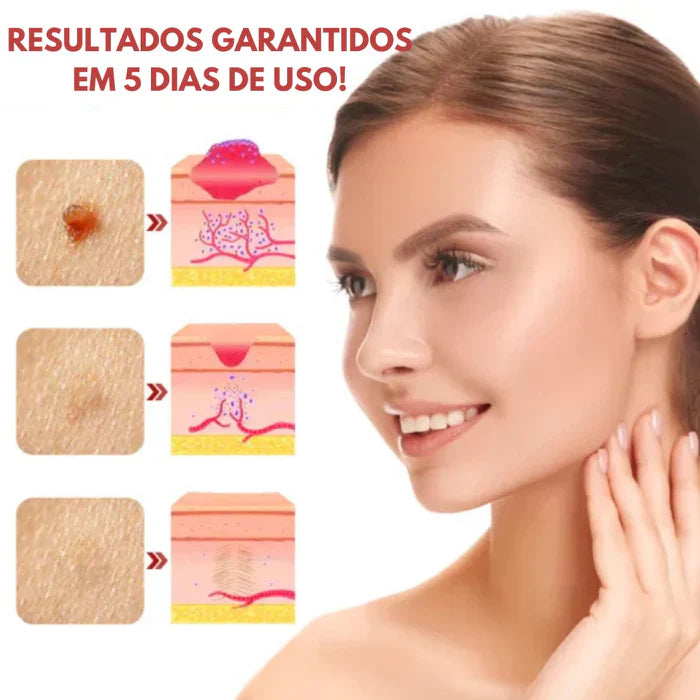 Remova Verrugas, manchas e marcas - VerruClean™  COMPRE 1 LEVE 2