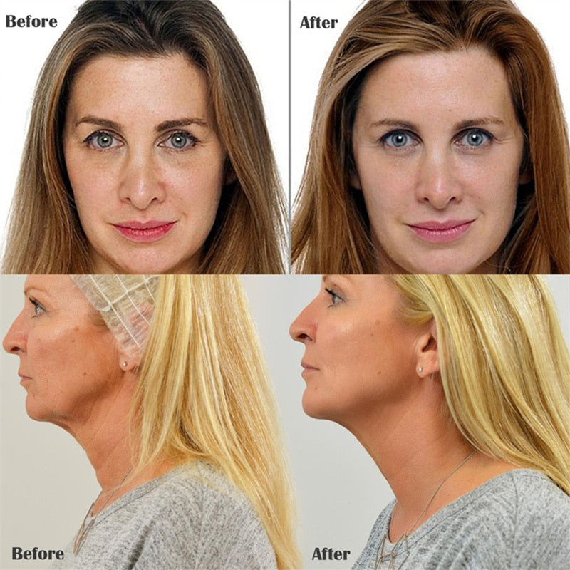 Remoção de rugas e enchimento facial